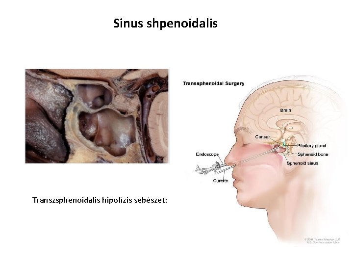 Sinus shpenoidalis Transzsphenoidalis hipofízis sebészet: 