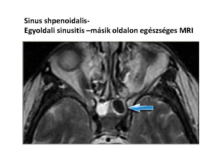 Sinus shpenoidalis. Egyoldali sinusitis –másik oldalon egészséges MRI 