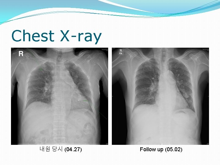 Chest X-ray 내원 당시 (04. 27) Follow up (05. 02) 