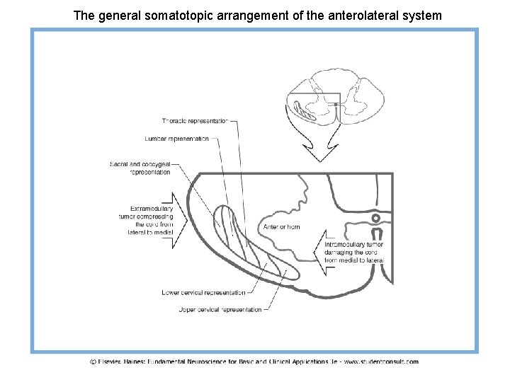 The general somatotopic arrangement of the anterolateral system 