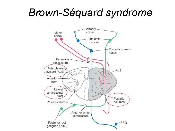 Brown-Séquard syndrome 