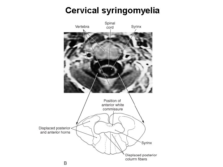 Cervical syringomyelia 