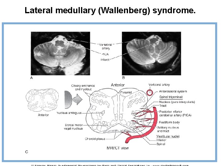 Lateral medullary (Wallenberg) syndrome. 
