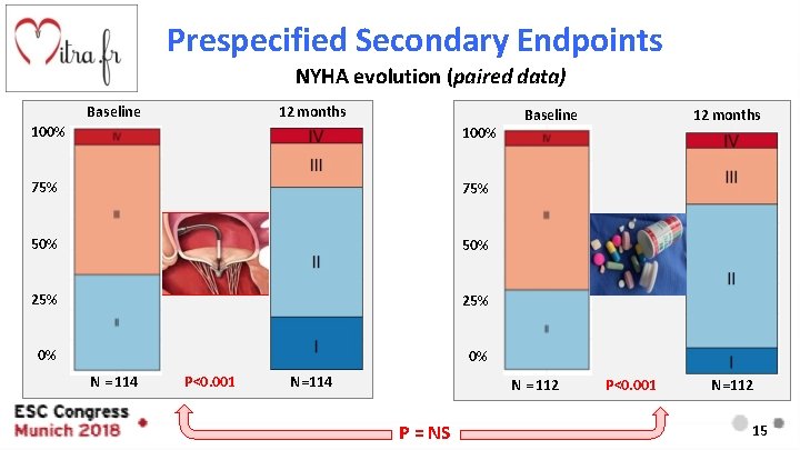 Prespecified Secondary Endpoints NYHA evolution (paired data) Baseline 12 months 100% 75% 50% 25%