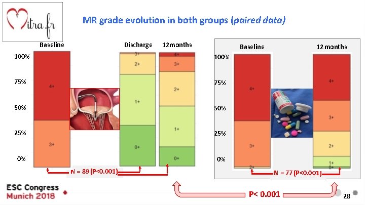 MR grade evolution in both groups (paired data) Baseline Discharge 12 months Baseline 100%