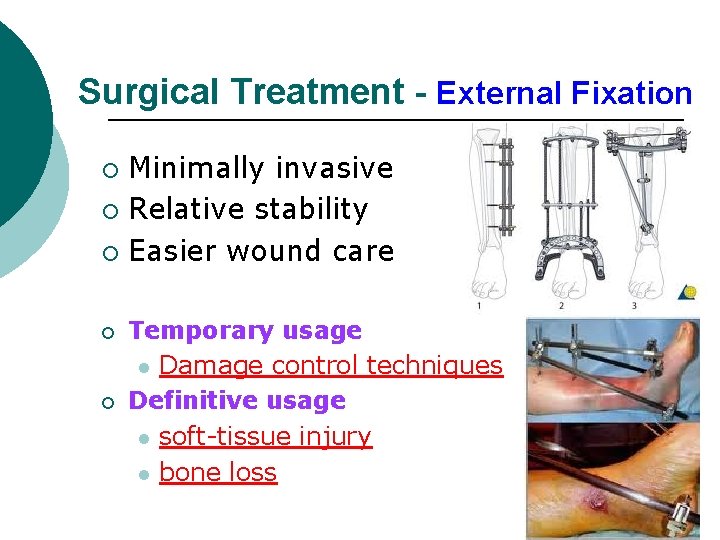 Surgical Treatment - External Fixation Minimally invasive ¡ Relative stability ¡ Easier wound care