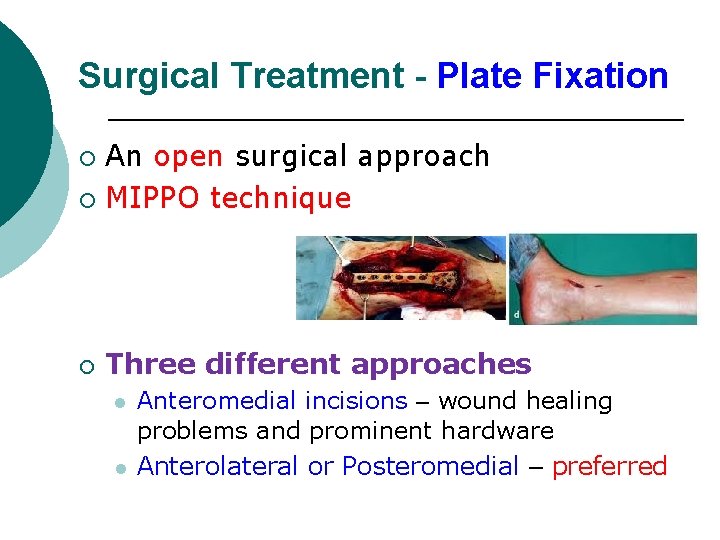 Surgical Treatment - Plate Fixation An open surgical approach ¡ MIPPO technique ¡ ¡