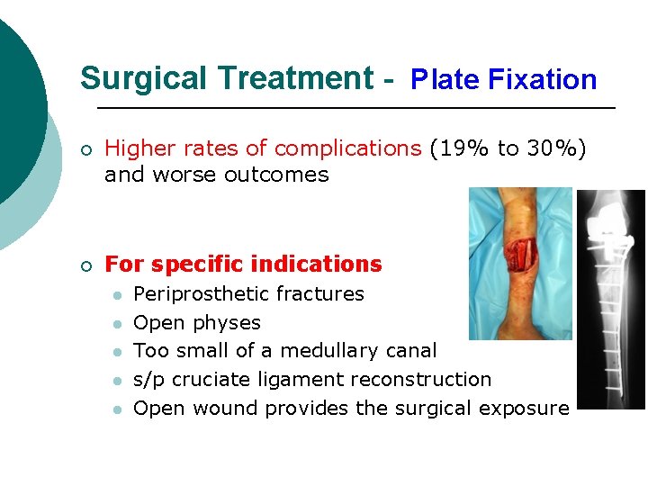 Surgical Treatment - Plate Fixation ¡ Higher rates of complications (19% to 30%) and