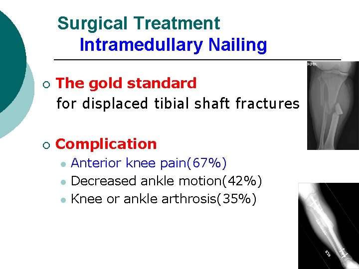 Surgical Treatment Intramedullary Nailing ¡ ¡ The gold standard for displaced tibial shaft fractures