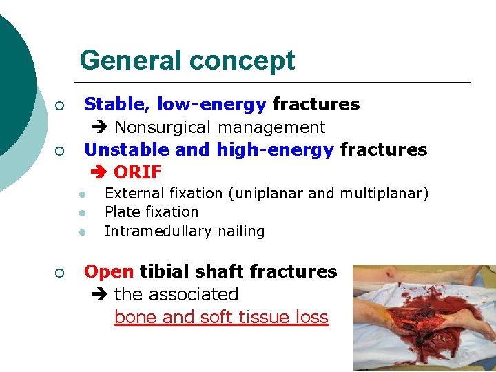 General concept ¡ ¡ Stable, low-energy fractures Nonsurgical management Unstable and high-energy fractures ORIF