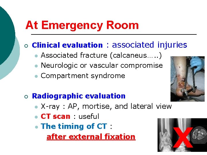 At Emergency Room ¡ ¡ Clinical evaluation : associated injuries l Associated fracture (calcaneus….