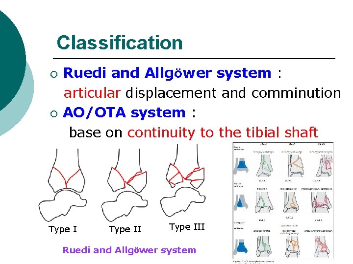 Classification ¡ ¡ Ruedi and Allgöwer system : articular displacement and comminution AO/OTA system
