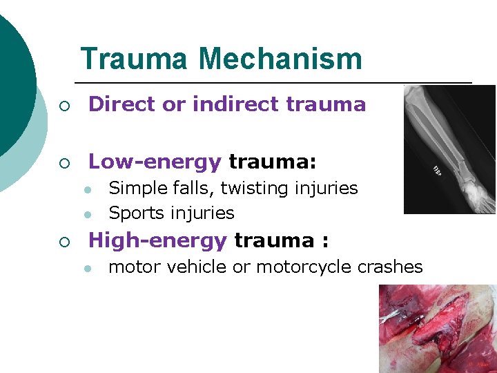 Trauma Mechanism ¡ Direct or indirect trauma ¡ Low-energy trauma: l l ¡ Simple