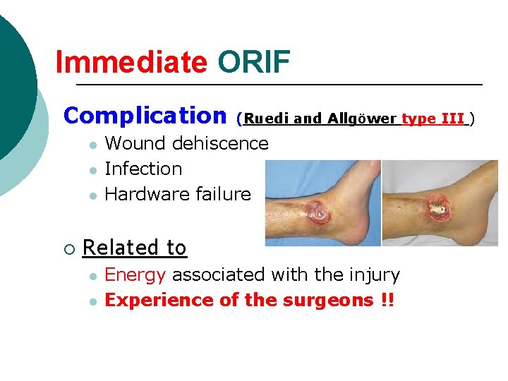 Immediate ORIF Complication l l l ¡ (Ruedi and Allgöwer type III ) Wound