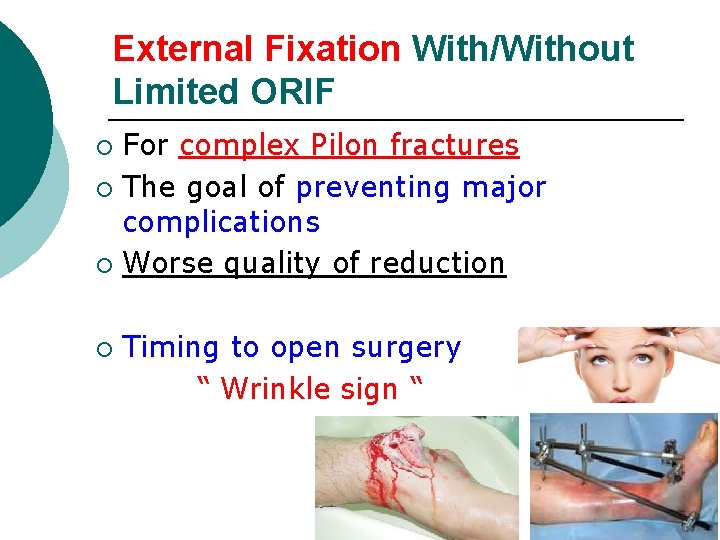 External Fixation With/Without Limited ORIF For complex Pilon fractures ¡ The goal of preventing