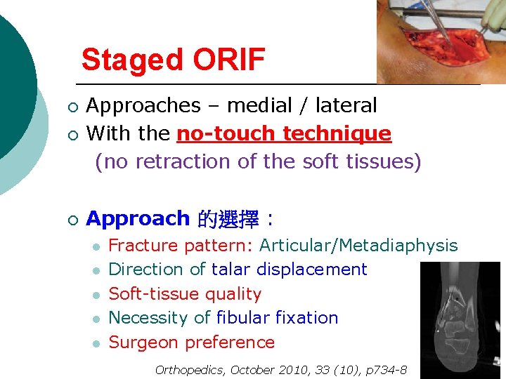 Staged ORIF ¡ Approaches – medial / lateral With the no-touch technique (no retraction