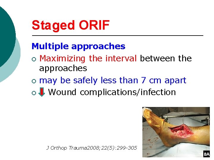 Staged ORIF Multiple approaches ¡ Maximizing the interval between the approaches ¡ may be