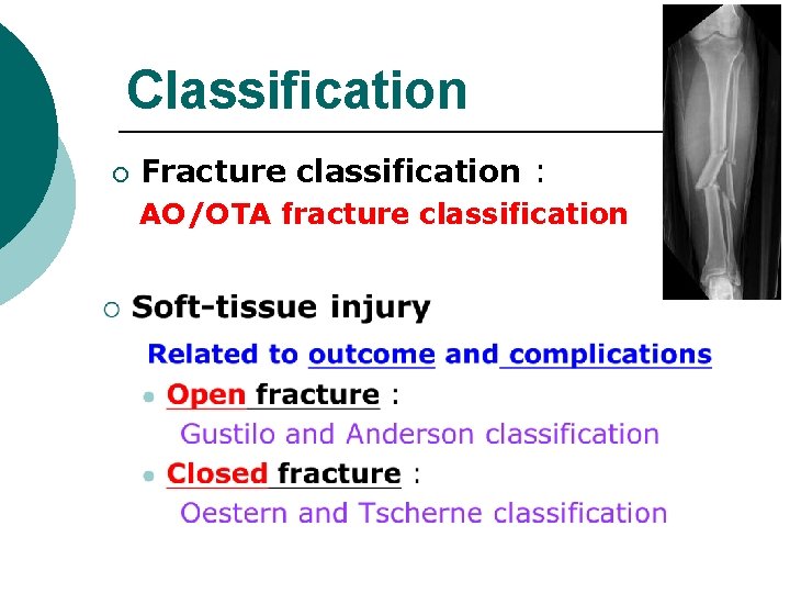 Classification ¡ Fracture classification : AO/OTA fracture classification 
