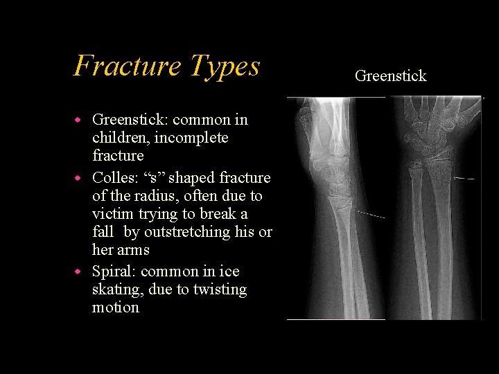 Fracture Types Greenstick: common in children, incomplete fracture w Colles: “s” shaped fracture of