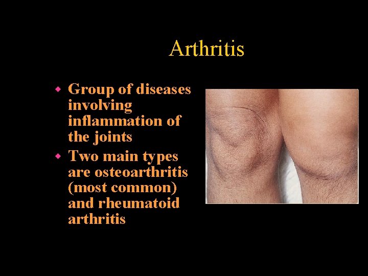 Arthritis Group of diseases involving inflammation of the joints w Two main types are