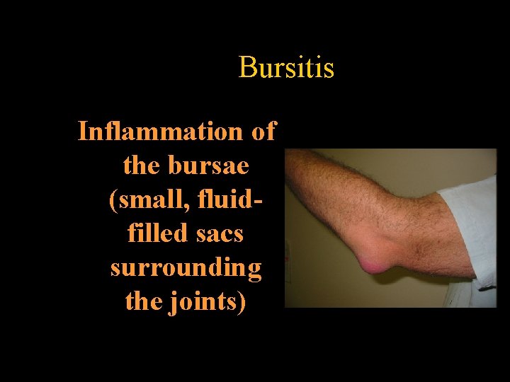 Bursitis Inflammation of the bursae (small, fluidfilled sacs surrounding the joints) 