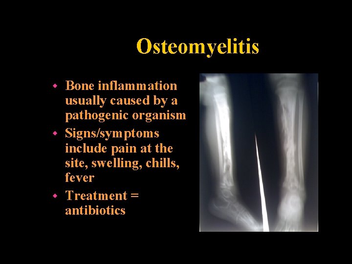 Osteomyelitis Bone inflammation usually caused by a pathogenic organism w Signs/symptoms include pain at