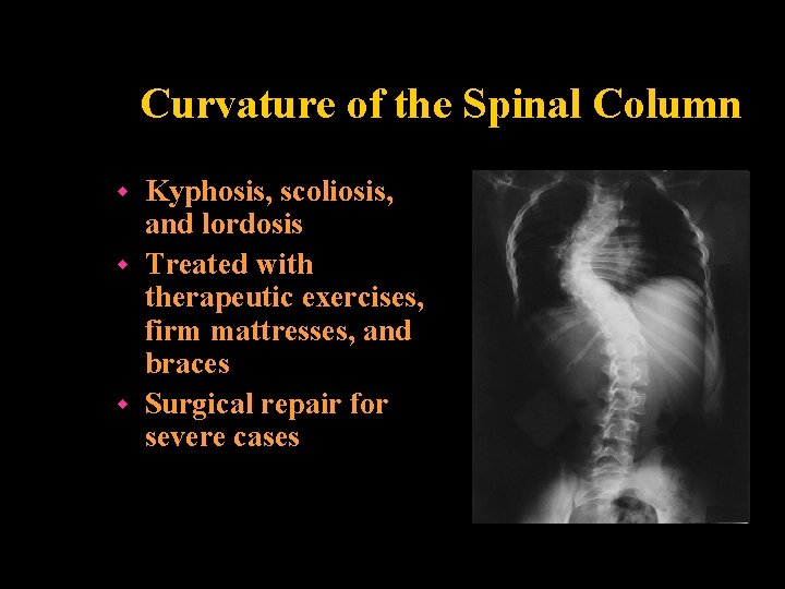 Curvature of the Spinal Column Kyphosis, scoliosis, and lordosis w Treated with therapeutic exercises,