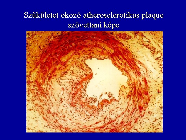 Szűkületet okozó atherosclerotikus plaque szövettani képe 