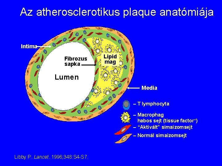 Az atherosclerotikus plaque anatómiája Intima Fibrozus sapka Lipid mag Lumen Media – T lymphocyta