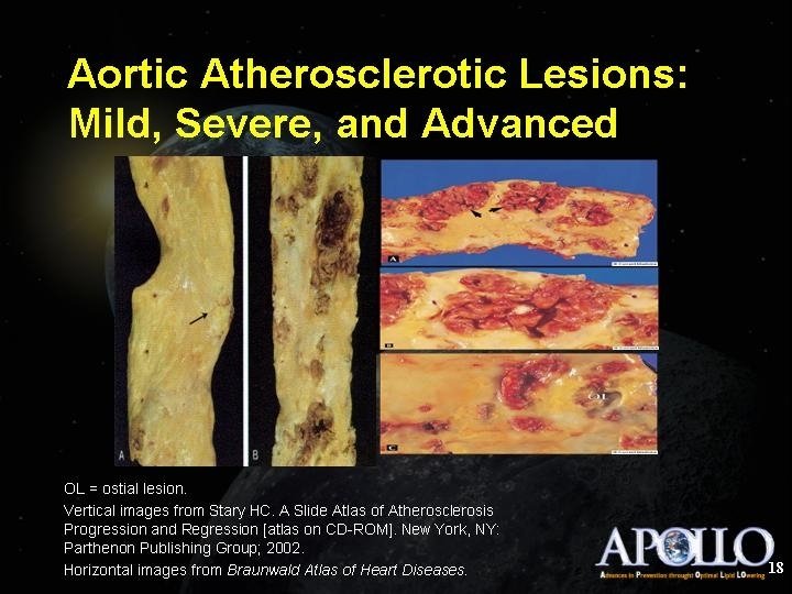Aortic Atherosclerotic Lesions: Mild, Severe, and Advanced 