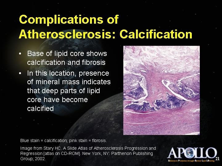 Complications of Atherosclerosis: Calcification 