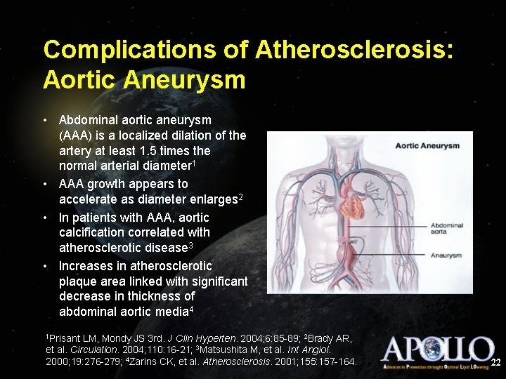 Complications of Atherosclerosis: Aortic Aneurysm 