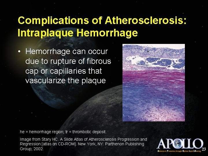 Complications of Atherosclerosis: Intraplaque Hemorrhage 