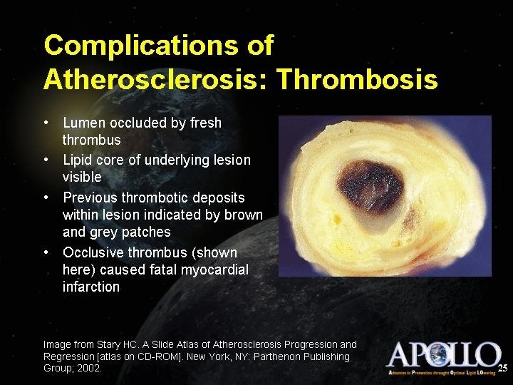 Complications of Atherosclerosis: Thrombosis 