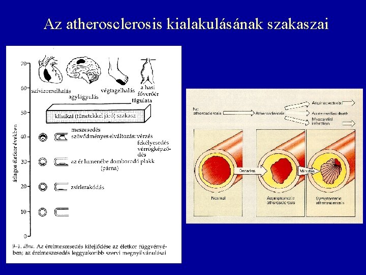 Az atherosclerosis kialakulásának szakaszai 