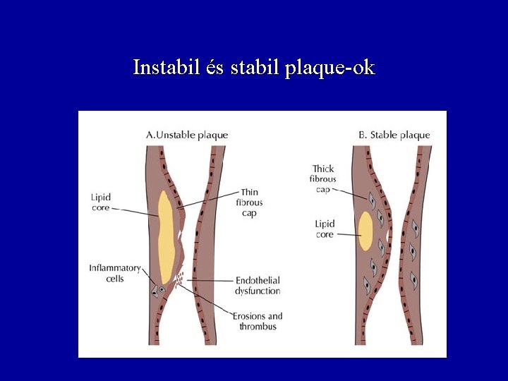 Instabil és stabil plaque-ok 