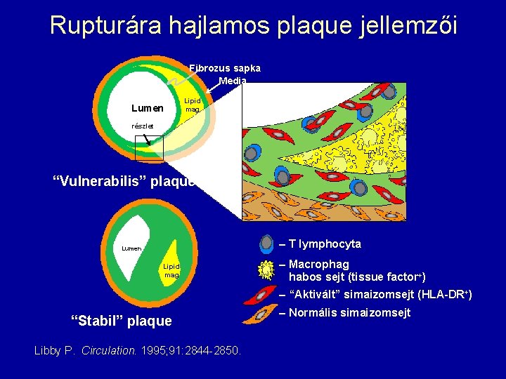 Rupturára hajlamos plaque jellemzői Fibrozus sapka Media Lumen Lipid mag részlet “Vulnerabilis” plaque –