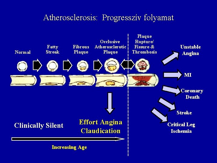 Atherosclerosis: Progresszív folyamat Normal Fatty Streak Fibrous Plaque Occlusive Atherosclerotic Plaque Rupture/ Fissure &