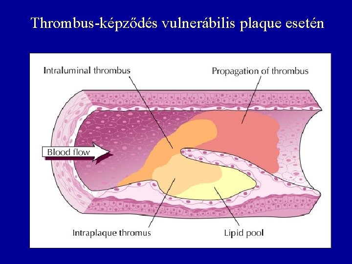 Thrombus-képződés vulnerábilis plaque esetén 