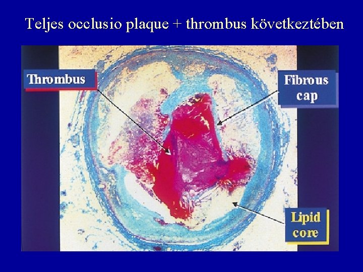 Teljes occlusio plaque + thrombus következtében 