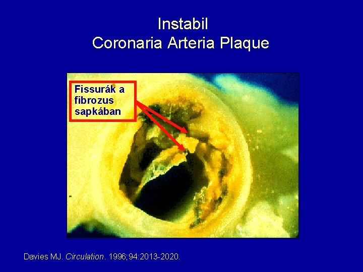 Instabil Coronaria Arteria Plaque Fissurák a fibrozus sapkában Davies MJ. Circulation. 1996; 94: 2013