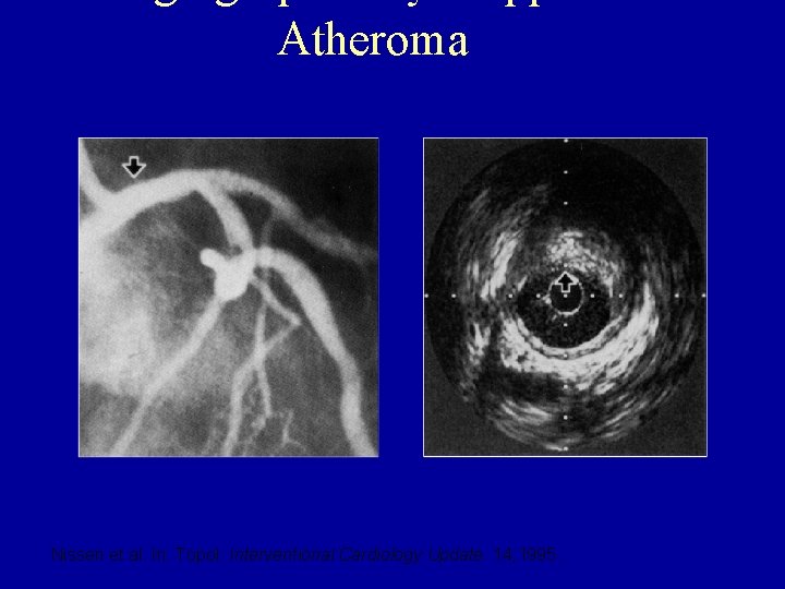 Atheroma Nissen et al. In: Topol. Interventional Cardiology Update. 14; 1995. 