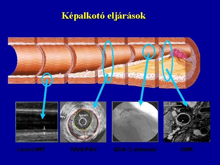 Képalkotó eljárások Carotid IMT IVUS-PAV QCA-% stenosis CMR 