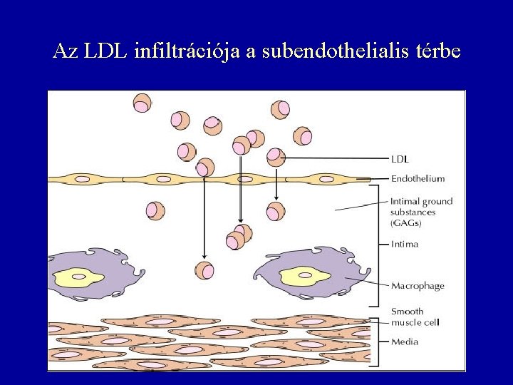 Az LDL infiltrációja a subendothelialis térbe 