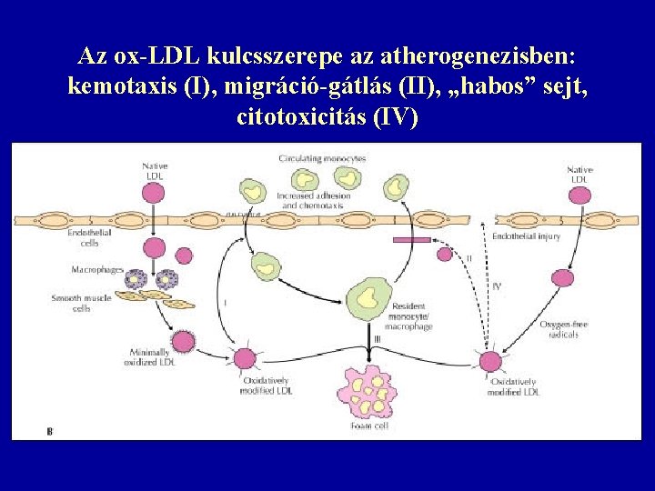 Az ox-LDL kulcsszerepe az atherogenezisben: kemotaxis (I), migráció-gátlás (II), „habos” sejt, citotoxicitás (IV) 