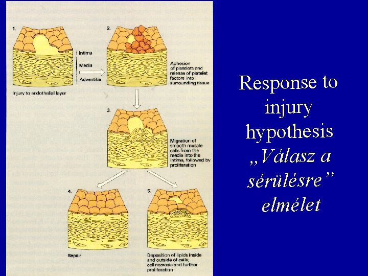 Response to injury hypothesis „Válasz a sérülésre” elmélet 