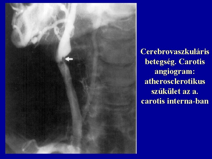 Cerebrovaszkuláris betegség. Carotis angiogram: atherosclerotikus szűkület az a. carotis interna-ban 
