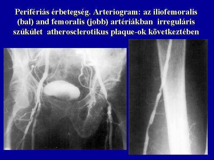 Perifériás érbetegség. Arteriogram: az iliofemoralis (bal) and femoralis (jobb) artériákban irreguláris szűkűlet atherosclerotikus plaque-ok