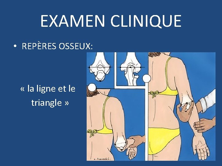 EXAMEN CLINIQUE • REPÈRES OSSEUX: « la ligne et le triangle » 