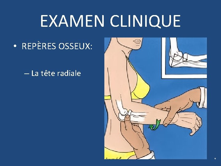 EXAMEN CLINIQUE • REPÈRES OSSEUX: – La tête radiale 